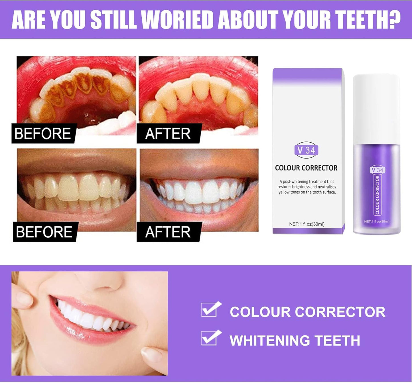Hismile Teeth Whitening